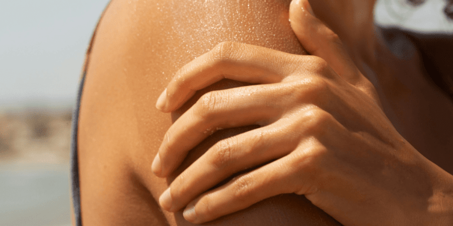 Nudegėte saulėje? Kaip gelbėti odą ir kodėl liaudiškas priemones reikėtų pamiršti?